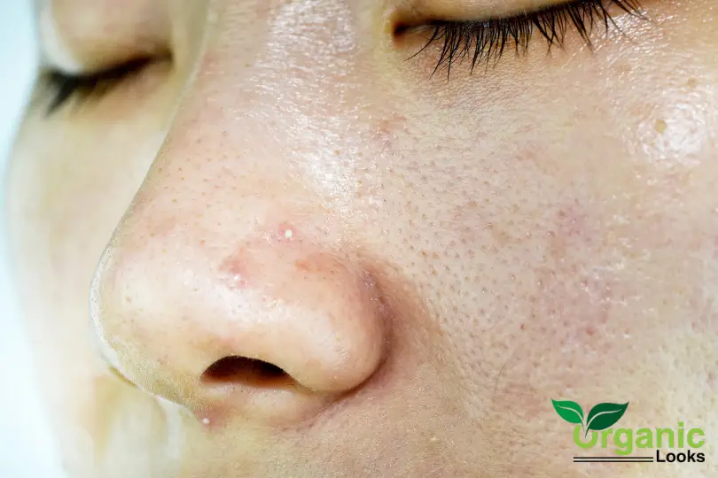 Tips to Get Clear Skin Naturally for People With Oily Skin