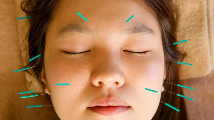 cosmetic facial acupuncture